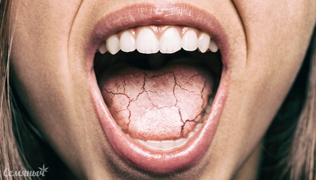 Сухость во рту